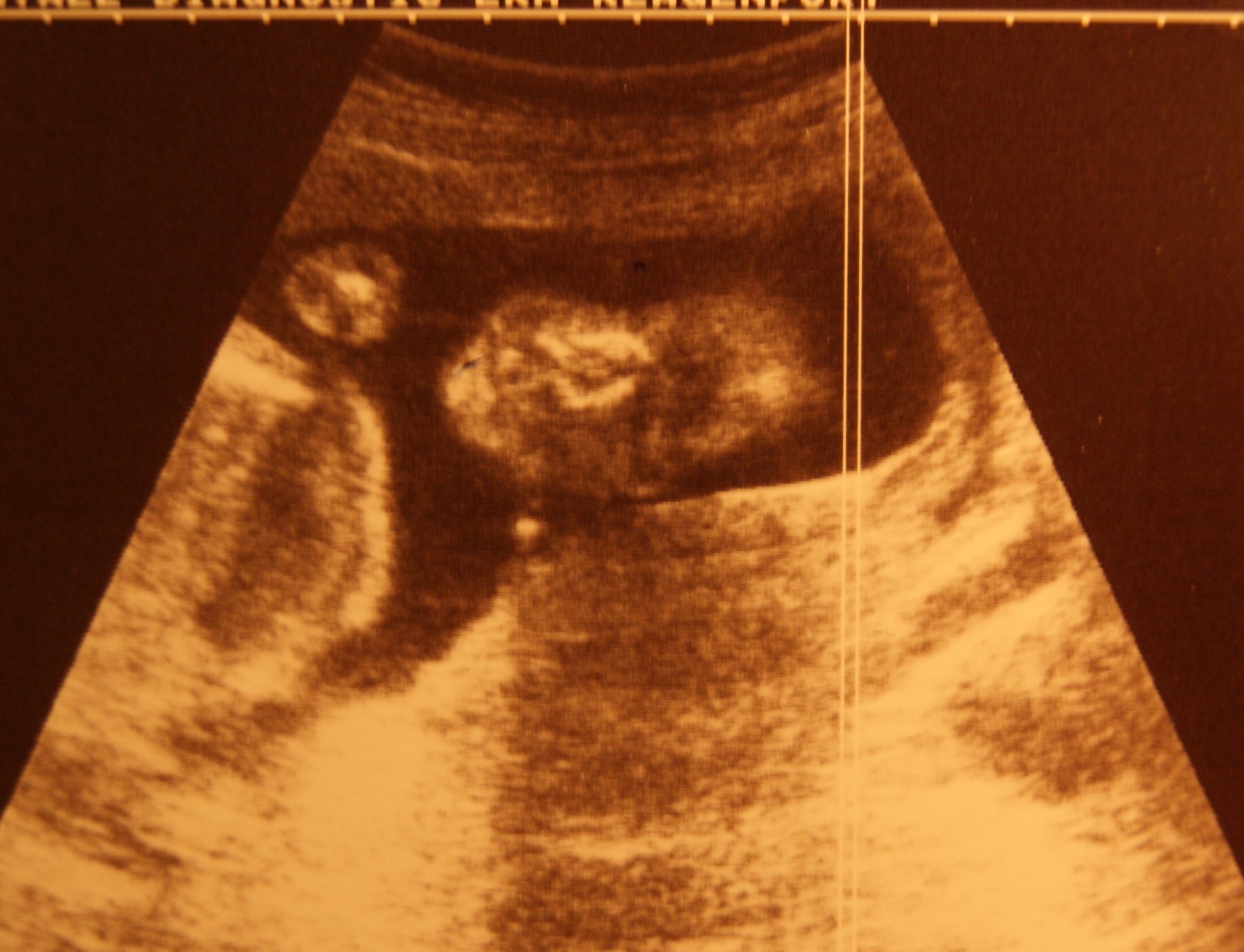 Abtreibung ist niemals eine Lösung